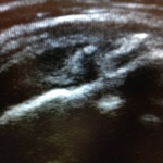 rotator_cuff_tear_1