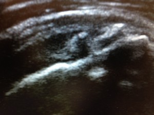 Rotator Cuff Tears