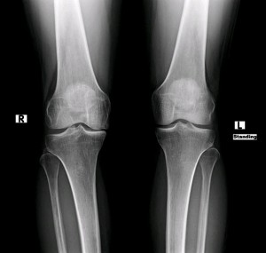 Knee Arthritis and PRP: 78% improvement