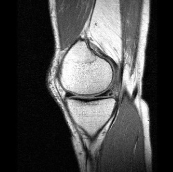 Knee Pain Resolved with Stem Cells