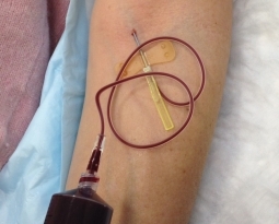 PRP and Joint Pain Improved