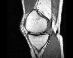 Knee Pain Resolved with Stem Cells