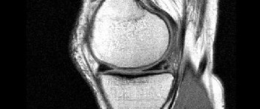 Knee Pain Resolved with Stem Cells